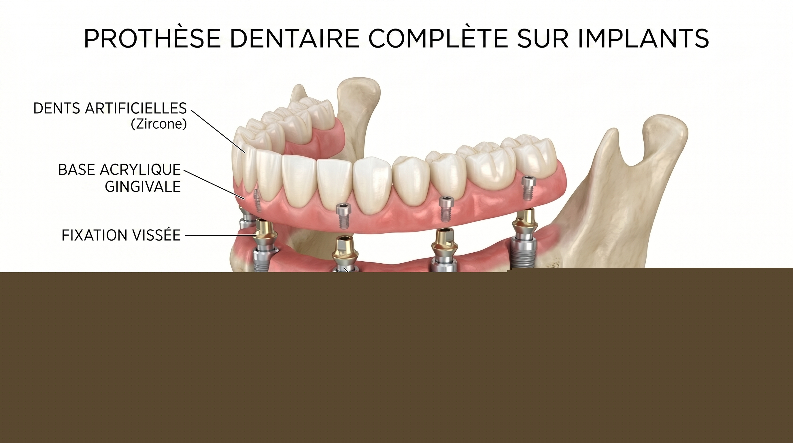 Schéma anatomique d'une prothèse complète sur implants All-on-4 avec dents en zircone